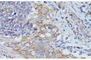 Immunohistochemistry of paraffin-embedded Human lung cancer using CTTN Polyclonal Antibody at dilution of 1:100 (40x lens). (Cortactin antibody)