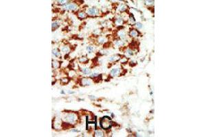 Formalin-fixed and paraffin-embedded human hepatocellular carcinoma tissue reacted with PRKAB1 polyclonal antibody  , which was peroxidase-conjugated to the secondary antibody, followed by AEC staining . (PRKAB1 antibody  (N-Term))