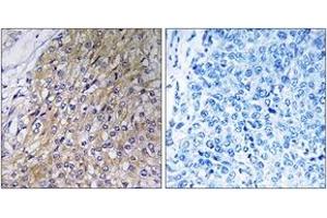 Immunohistochemistry analysis of paraffin-embedded human breast carcinoma tissue, using GOLT1A Antibody. (GOLT1A antibody  (AA 40-89))