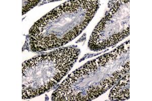 IHC testing of FFPE human colon cancer tissue with UBA2 antibody at 1ug/ml.