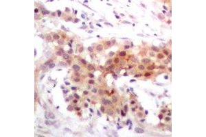 Immunohistochemical analysis of p300 staining in human breast cancer formalin fixed paraffin embedded tissue section. (p300 antibody)