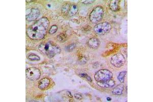 Immunohistochemical analysis of RPL35 staining in human lung cancer formalin fixed paraffin embedded tissue section. (RPL35 antibody  (Center))