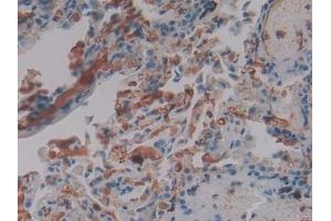 Detection of FGg in Human Lung Tissue using Polyclonal Antibody to Fibrinogen Gamma (FGg) (FGG antibody  (AA 166-416))