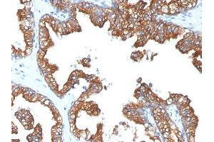 Formalin-fixed, paraffin-embedded human Prostate Carcinoma stained with Cytokeratin 8/18 Monoclonal Antibody (5D3). (CK8 & CK18 antibody)