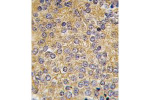 Formalin-fixed and paraffin-embedded human prostata carcinoma tissue reacted with PLAU antibody (N-term), which was peroxidase-conjugated to the secondary antibody, followed by DAB staining. (PLAU antibody  (N-Term))