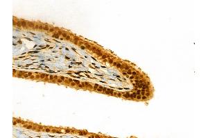 ABIN6261157 and ABIN6266615 at 1/100 staining Human ovarian cancer and adjacent normal tissues by IHC-P. (Cyclin L1 antibody  (C-Term))