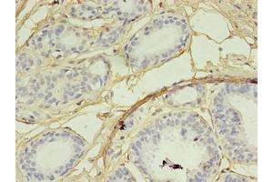 Immunohistochemistry of paraffin-embedded human breast cancer using ABIN7168555 at dilution of 1:100 (SKP2 antibody  (AA 1-424))