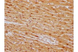 IHC image of ABIN7180448 diluted at 1:100 and staining in paraffin-embedded human liver cancer performed on a Leica BondTM system. (Liver Arginase antibody)