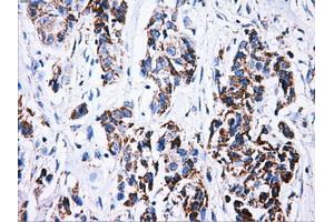 Immunohistochemical staining of paraffin-embedded Carcinoma of liver tissue using anti-ATP5Bmouse monoclonal antibody. (ATP5B antibody)