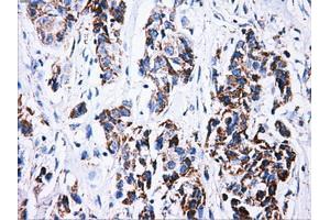 Immunohistochemical staining of paraffin-embedded Carcinoma of liver tissue using anti-ATP5Bmouse monoclonal antibody.