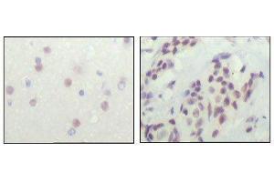 Immunohistochemical analysis of paraffin-embedded human cerebra (left) and breast carcinoma tissue (right), showing nuclear location with DAB staining using NCOR1 mouse mAb. (NCOR1 antibody  (AA 1-192))
