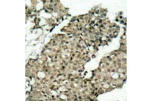 Immunohistochemistry of paraffin-embedded human breast carcinoma using Phospho-G3BP1-S232 antibody (ABIN2988019). (G3BP1 antibody  (pSer232))