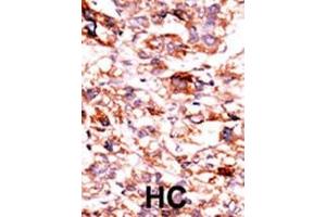 Formalin-fixed and paraffin-embedded human cancer tissue reacted with the primary antibody, which was peroxidase-conjugated to the secondary antibody, followed by AEC staining. (ADCK5 antibody  (C-Term))