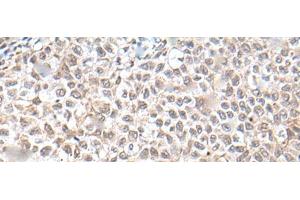 Immunohistochemistry of paraffin-embedded Human ovarian cancer tissue using UBN1 Polyclonal Antibody at dilution of 1:130(x200) (Ubinuclein 1 antibody)