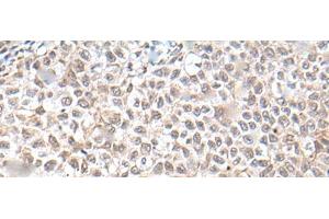 Immunohistochemistry of paraffin-embedded Human ovarian cancer tissue using UBN1 Polyclonal Antibody at dilution of 1:130(x200)