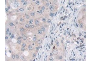 Detection of NID2 in Human Breast cancer Tissue using Polyclonal Antibody to Nidogen 2 (NID2) (NID2 antibody  (AA 31-289))