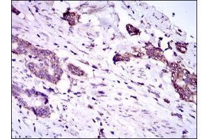 Immunohistochemical analysis of paraffin-embedded esophageal cancer tissues using DNAL4 mouse mAb with DAB staining. (DNAL4 antibody  (AA 1-105))