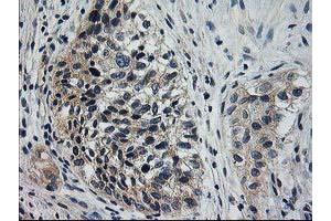 Immunohistochemical staining of paraffin-embedded Carcinoma of Human bladder tissue using anti-XPNPEP3 mouse monoclonal antibody. (XPNPEP3 antibody)