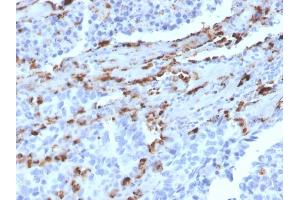 Formalin-fixed, paraffin-embedded human Lung Adenocarcinoma stained with Napsin A Mouse Monoclonal Antibody (NAPSA/3309).