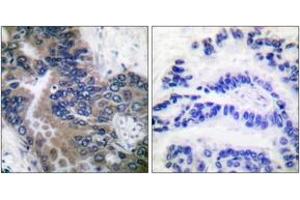 Immunohistochemistry analysis of paraffin-embedded human lung carcinoma tissue, using APAF-1-ALT Antibody. (APAF1 antibody  (AA 289-338))