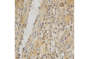 Immunohistochemistry of paraffin-embedded human stomach cancer using TNFRSF11B antibody at dilution of 1:200 (x400 lens)
