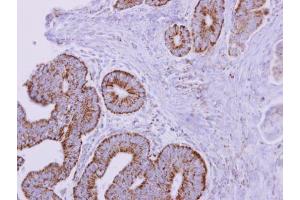 IHC-P Image ACADM antibody detects ACADM protein at mitochondria on human colon carcinoma by immunohistochemical analysis. (Medium-Chain Specific Acyl-CoA Dehydrogenase, Mitochondrial (MCAD) (Center) antibody)