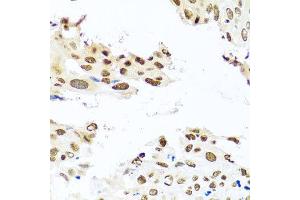 Immunohistochemistry of paraffin-embedded human lung cancer using RAB3IP antibody at dilution of 1:100 (x40 lens). (RAB3IP antibody)