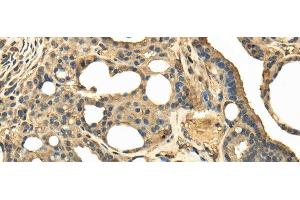 Immunohistochemistry of paraffin-embedded Human thyroid cancer tissue using TRPC4AP Polyclonal Antibody at dilution 1:40 (TRPC4AP antibody)