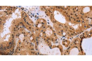 Immunohistochemistry of paraffin-embedded Human thyroid cancer using EPDR1 Polyclonal Antibody at dilution of 1:40 (EPDR1 antibody)