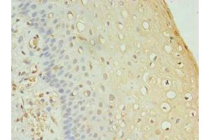 Immunohistochemistry of paraffin-embedded human cervical cancer using ABIN7165402 at dilution of 1:100 (FAM136A antibody  (AA 2-138))