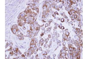 IHC-P Image Immunohistochemical analysis of paraffin-embedded OECM1 xenograft, using Fatty Acid Synthase, antibody at 1:500 dilution. (Fatty Acid Synthase antibody  (N-Term))