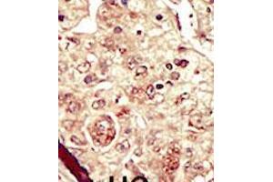 Formalin-fixed and paraffin-embedded human cancer tissue reacted with the primary antibody, which was peroxidase-conjugated to the secondary antibody, followed by DAB staining. (STK16 antibody  (C-Term))