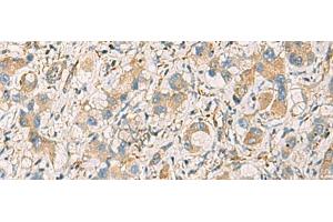 Immunohistochemistry of paraffin-embedded Human liver cancer tissue using GNAZ Polyclonal Antibody at dilution of 1:70(x200) (GNaZ antibody)