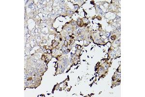 Immunohistochemistry of paraffin-embedded human lung cancer using Mucin 5AC (MUC5AC) antibody (ABIN7268694) at dilution of 1:50 (40x lens).