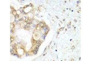 Immunohistochemistry of paraffin-embedded Human liver cancer using VTI1B Polyclonal Antibody at dilution of 1:100 (40x lens). (VTI1B antibody)