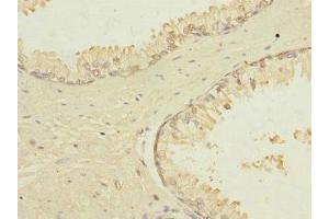 Immunohistochemistry of paraffin-embedded human prostate cancer using ABIN7172867 at dilution of 1:100