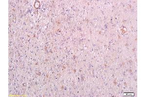 Formalin-fixed and paraffin embedded human endometrial carcinoma labeled with Anti-phospho-PRKCQ(Thr538) Polyclonal Antibody, Unconjugated (ABIN711746) at 1:200 followed by conjugation to the secondary antibody