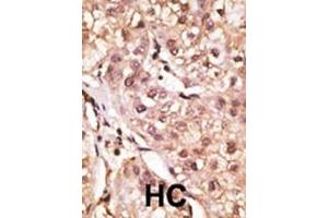 Formalin-fixed and paraffin-embedded human cancer tissue reacted with the primary antibody, which was peroxidase-conjugated to the secondary antibody, followed by DAB staining. (IL29 antibody  (AA 54-85))