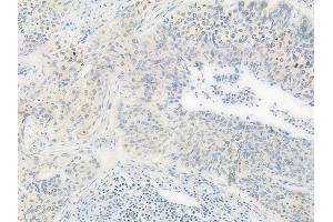 ABIN6261112 and ABIN6277999 at 1/100 staining human cervical carcinoma by IHC-P. (Cullin 4B antibody  (N-Term))