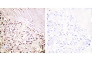 Peptide - +Immunohistochemical analysis of paraffin-embedded human breast carcinoma tissue using FANCD2 (Ab-222) antibody (#B0427). (FANCD2 antibody  (Ser222))