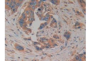 Detection of PK2 in Human Breast cancer Tissue using Polyclonal Antibody to Prokineticin 2 (PK2) (PROK2 antibody  (AA 30-128))