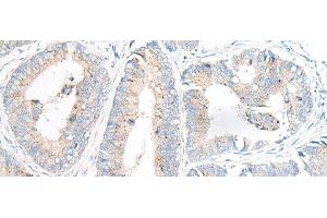 Immunohistochemistry of paraffin-embedded Human colorectal cancer tissue using GARNL3 Polyclonal Antibody at dilution of 1:100(x200) (GARNL3 antibody)