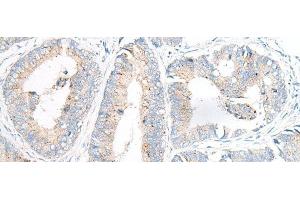 Immunohistochemistry of paraffin-embedded Human colorectal cancer tissue using GARNL3 Polyclonal Antibody at dilution of 1:100(x200)