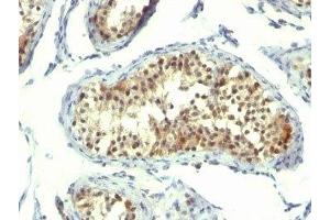 Formalin-fixed, paraffin-embedded human testicular carcinoma stained with Thymidylate Synthase antibody (TMS715). (TYMS antibody)