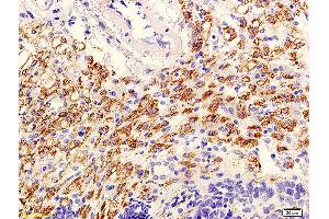 Formalin-fixed and paraffin embedded mouse tumor with labeled Anti-phospho-AKT/PKB(Ser473) Polyclonal Antibody, Unconjugated (ABIN729298) at 1:600, followed by conjugation to the secondary antibody and DAB staining (AKT 1/2/3 antibody  (pSer473))