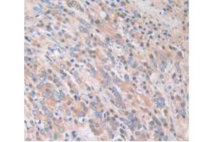 IHC-P analysis of Human Prostate Gland Cancer Tissue, with DAB staining. (Caspase 4 antibody  (AA 944-1148))
