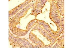 Immunohistochemistry of paraffin-embedded human endometrial cancer using ABIN7158346 at dilution of 1:100 (LIMS3 antibody  (AA 1-117))