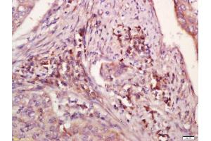 Formalin-fixed and paraffin embedded human laryngocarcinoma labeled with Anti-WDR26 Polyclonal Antibody, Unconjugated (ABIN729988) at 1:200 followed by conjugation to the secondary antibody and DAB staining (WDR26 antibody  (AA 101-200))