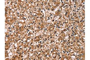 The image on the left is immunohistochemistry of paraffin-embedded Human prostate cancer tissue using ABIN7129785(HTR3C Antibody) at dilution 1/30, on the right is treated with fusion protein.