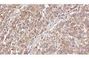 ABIN6279444 at 1/100 staining Human Melanoma tissue by IHC-P. (FGF9 antibody  (N-Term))